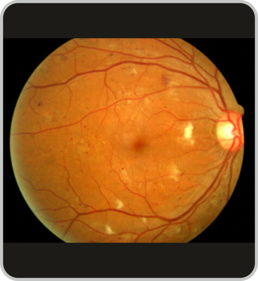 Diabetic Eye Screening